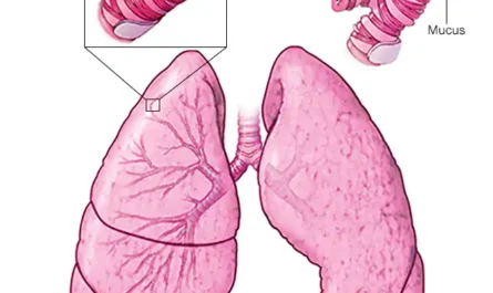 Asthma: A Comprehensive Guide