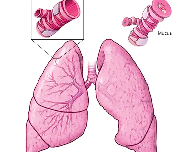 Asthma: A Comprehensive Guide