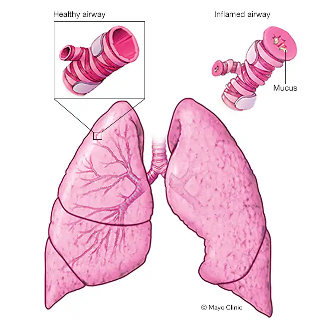 Asthma: A Comprehensive Guide