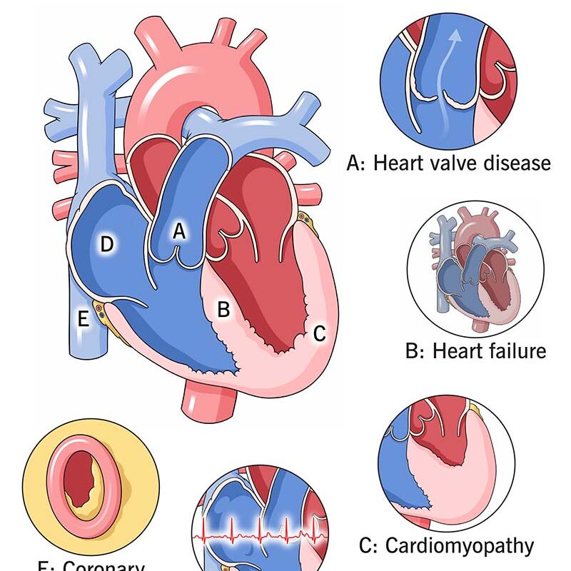 Heart Disease: Types, Causes, and Symptoms