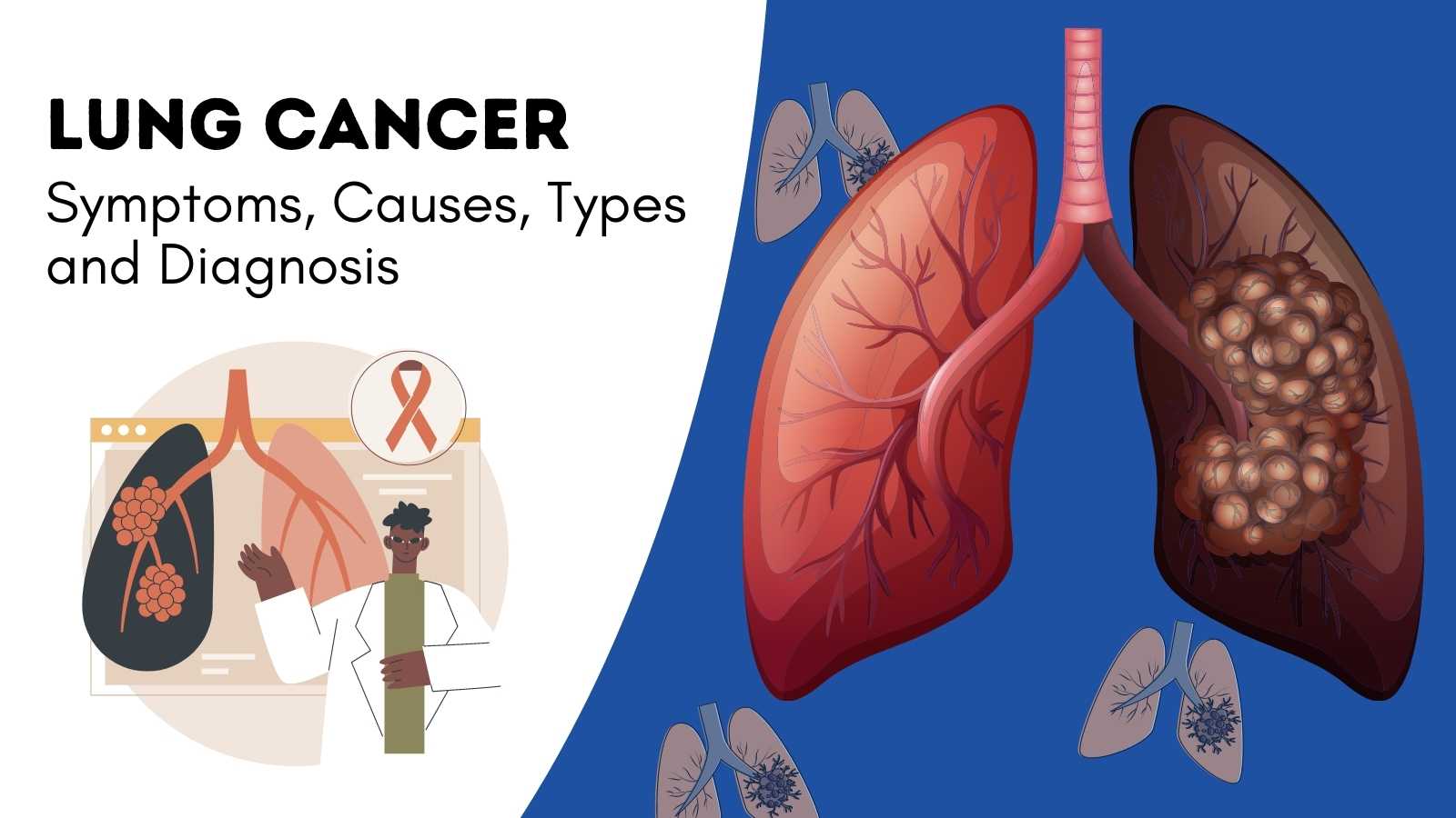Lung Cancer: Causes, Symptoms, Stages, Treatment & Prevention