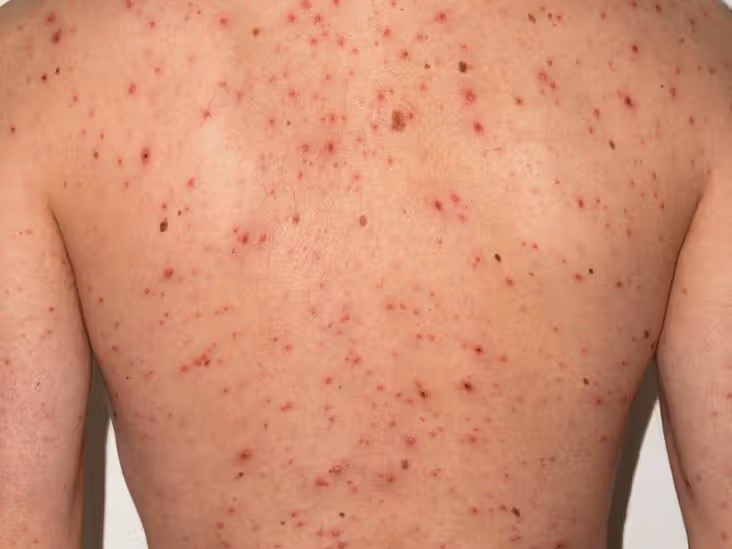 Chickenpox: Symptoms, Treatment, and the Role of Vaccination