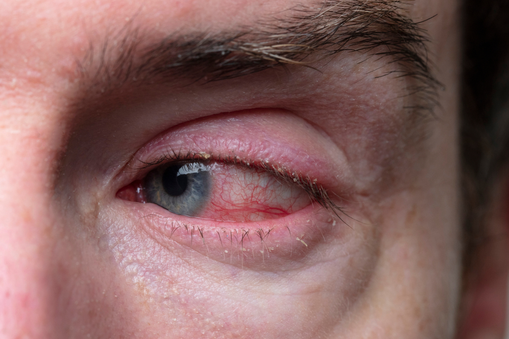 “Understanding Eye Diseases: Causes, Symptoms, and Treatment