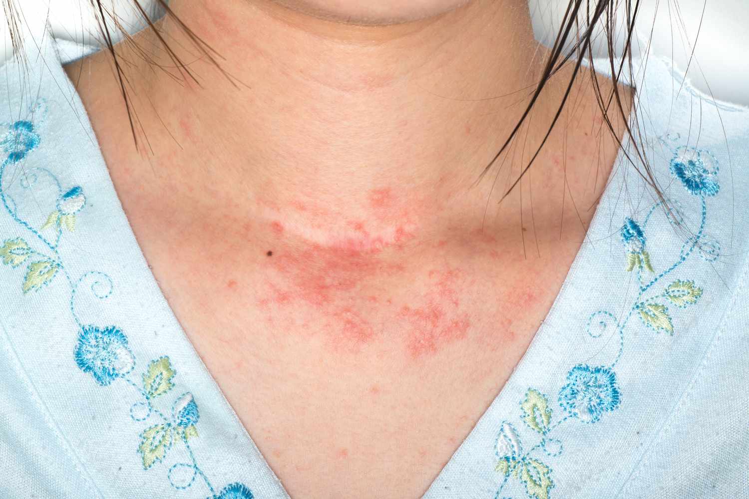 Skin Allergy Conditions Explained: Eczema, Hives, and More