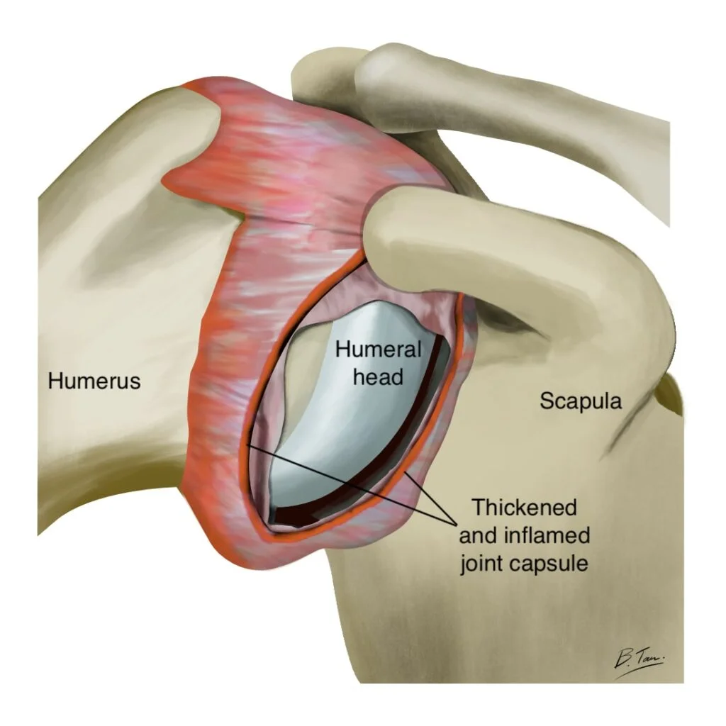 Frozen Shoulder: Causes & Effective Treatments