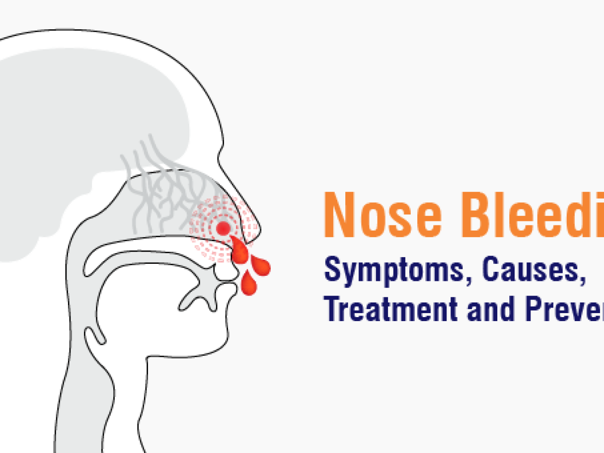 Nosebleeds A Complete Guide to Causes Treatment and Prevention