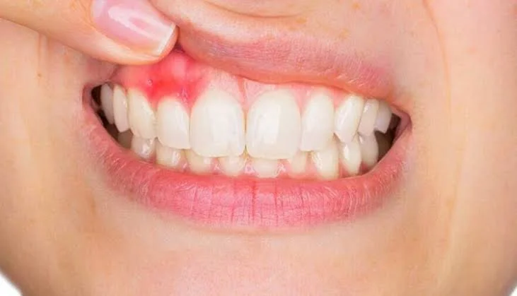 Understanding Periodontitis: Causes, Symptoms, and Treatments