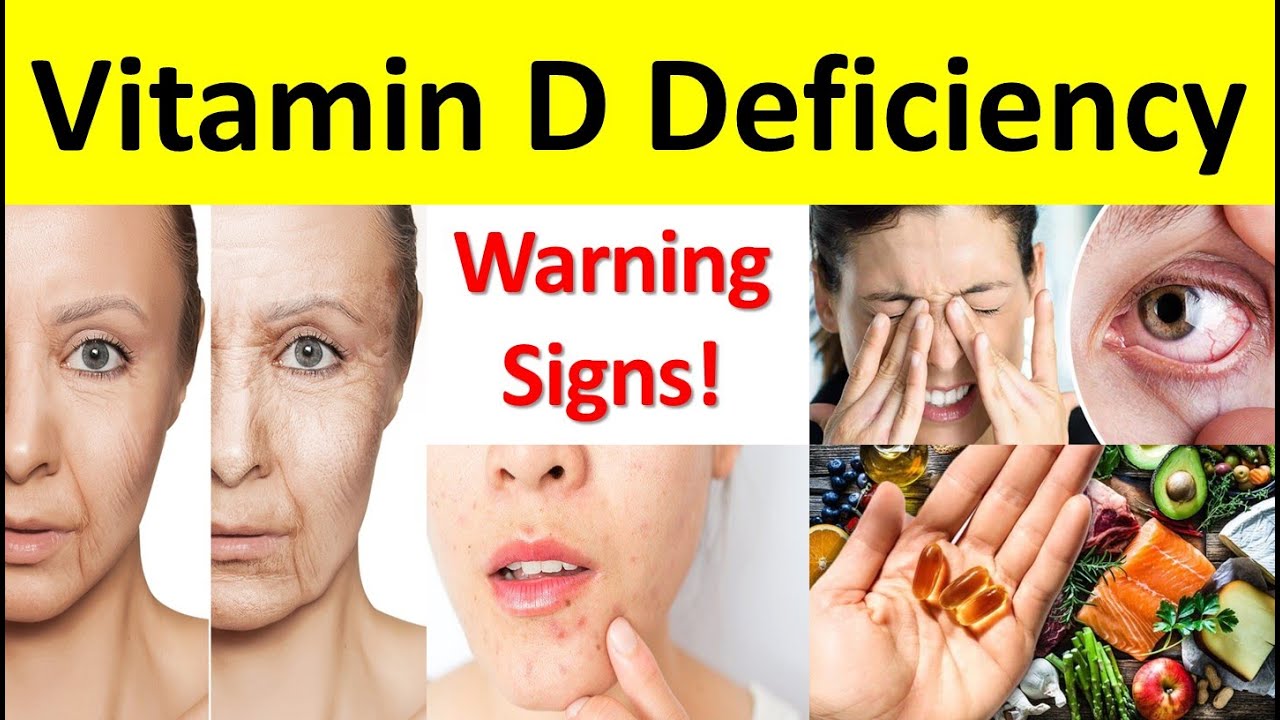 Vitamin D Deficiency: Causes, Symptoms, Treatment  & Prevention