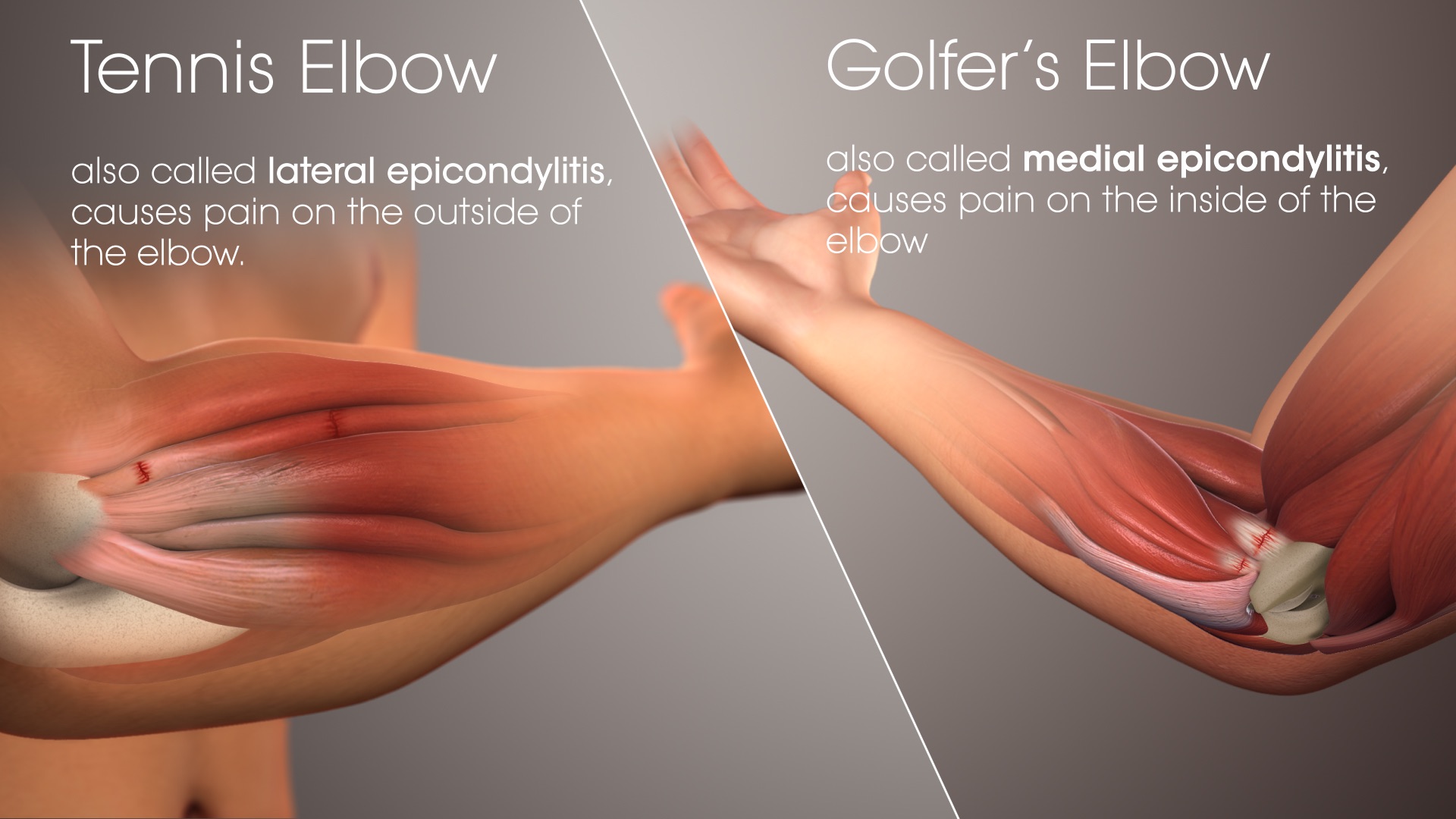 Tennis Elbow: Symptoms, Causes, and Treatment Options (Lateral Epicondylitis)