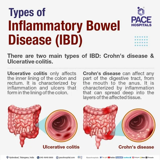 Inflammatory Bowel Disease: Symptoms, Causes, Diagnosis, and Treatment